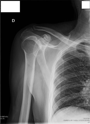 AP Shoulder Radiography